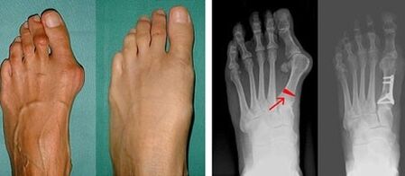 príznaky hallux valgus