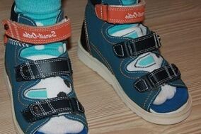 nosenie sandálov pre hallux valgus u dieťaťa