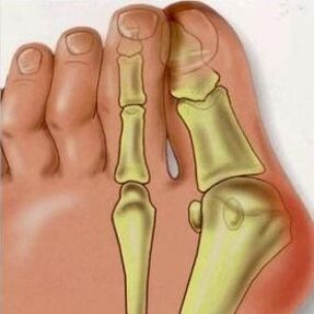 Dôvody pre Valgus