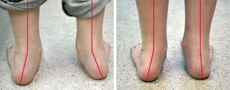 Nôh Valgus