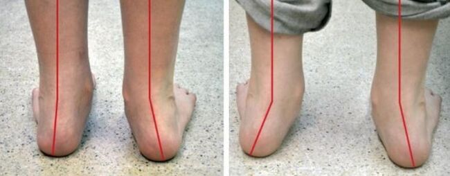 Nôh Valgus