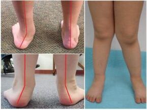 Valgus