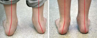 Zakrivenie valgus
